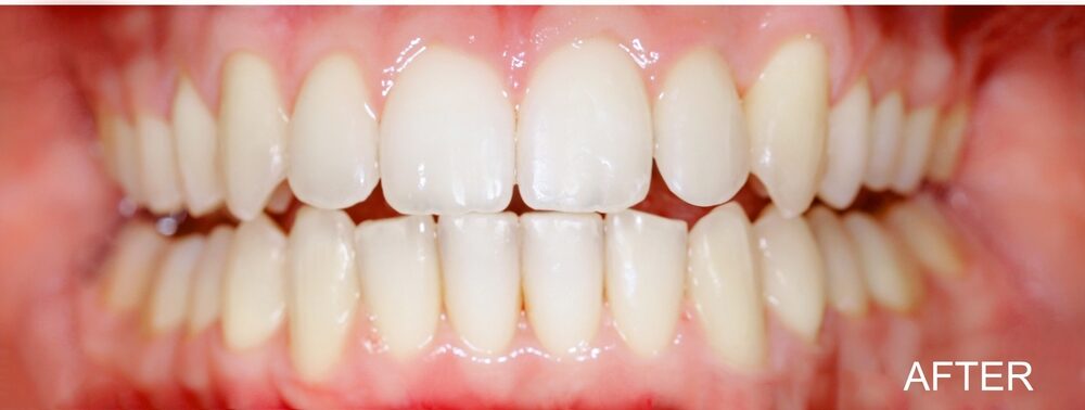 Comparison,Of,Before,And,After,Orthodontic,Treatment,,Illustrating,Crooked,Teeth Comparison,Of,Before,And,After,Orthodontic,Treatment,,Illustrating,Crooked,Teeth
