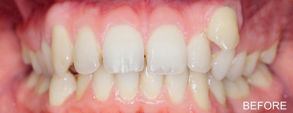 Comparison,Of,Before,And,After,Orthodontic,Treatment,,Illustrating,Crooked,Teeth Comparison,Of,Before,And,After,Orthodontic,Treatment,,Illustrating,Crooked,Teeth