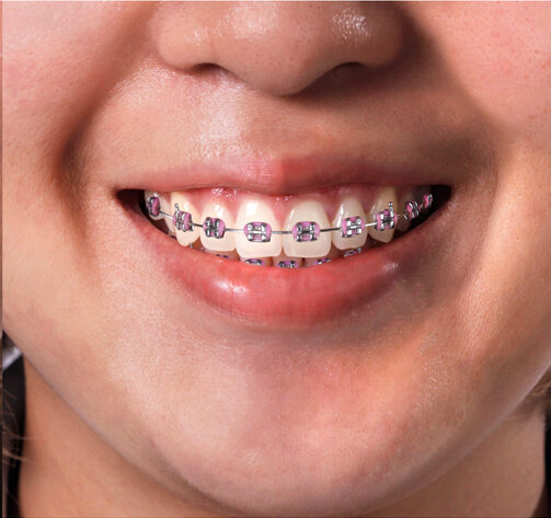 ORTHODONTICS tREATMENT ORTHODONTICS tREATMENT