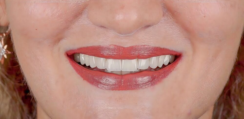 Aesthetic,Smile,Design,Treatment,In,Dental,Dentistry.,E-max,And,Zirconium Aesthetic,Smile,Design,Treatment,In,Dental,Dentistry.,E-max,And,Zirconium