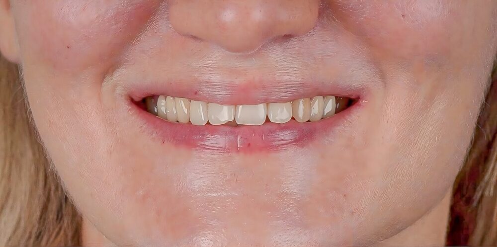 Aesthetic,Smile,Design,Treatment,In,Dental,Dentistry.,E-max,And,Zirconium Aesthetic,Smile,Design,Treatment,In,Dental,Dentistry.,E-max,And,Zirconium
