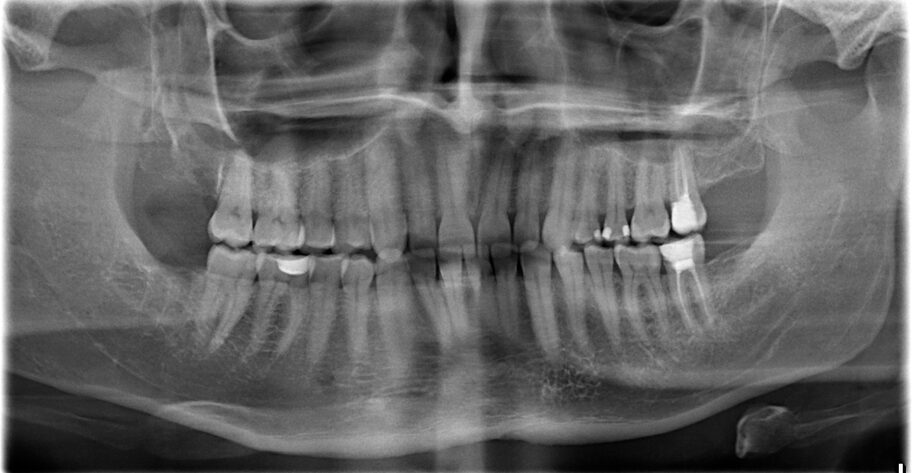 Radiography,Images,Before,And,After,The,Removal,Of,Three,Wisdom Radiography,Images,Before,And,After,The,Removal,Of,Three,Wisdom