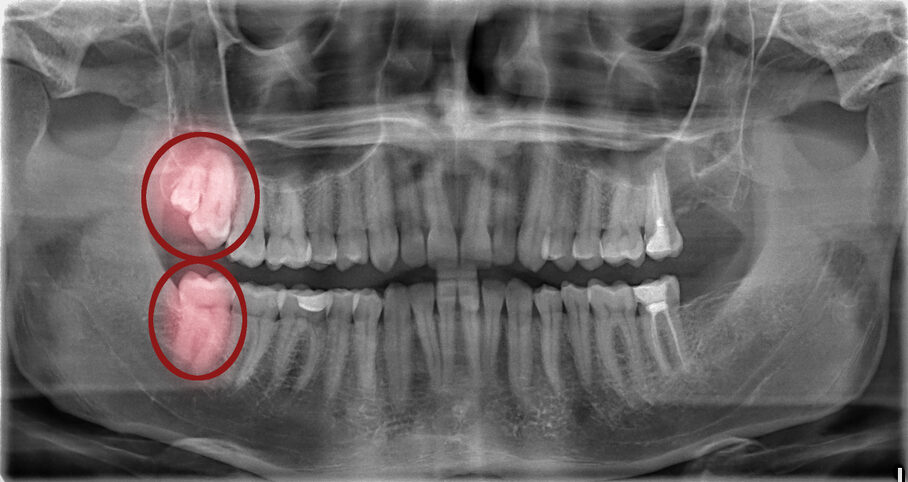 Radiography,Images,Before,And,After,The,Removal,Of,Three,Wisdom Radiography,Images,Before,And,After,The,Removal,Of,Three,Wisdom